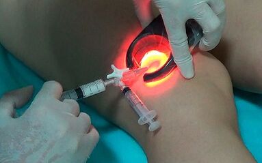 skleroterapia jako sposób leczenia żylaków na nogach